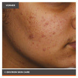 ENVIRON - Focus Care Clarity+ Botanical Infused Sebu-Spot Blemish Gel - Spezialpflege - Environ Skin Care - ZEITWUNDER Onlineshop - Kosmetik online kaufen
