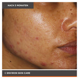 ENVIRON - Focus Care Clarity+ Vita-Botanical Sebu-ACE Oil - Feuchtigkeitspflege - Environ Skin Care - ZEITWUNDER Onlineshop - Kosmetik online kaufen
