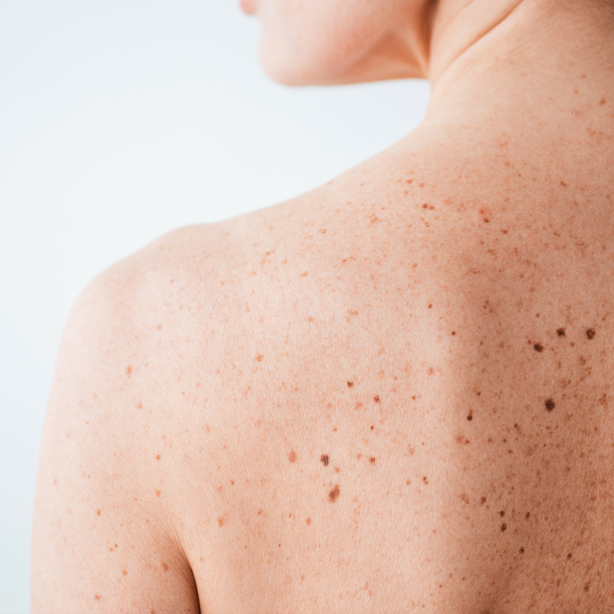 Nahaufnahme einer nackten Schulter und des oberen Rückens einer Person mit vielen sichtbaren Sommersprossen und Pigmentflecken, vor hellem, neutralem Hintergrund.